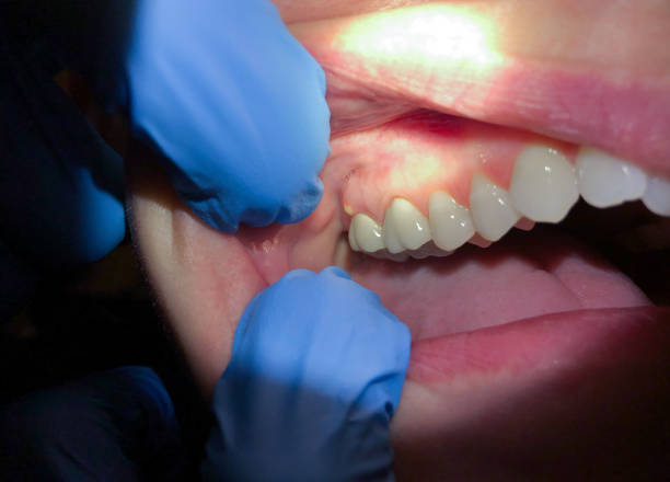 Best Emergency Tooth Extraction in Liberty, IN