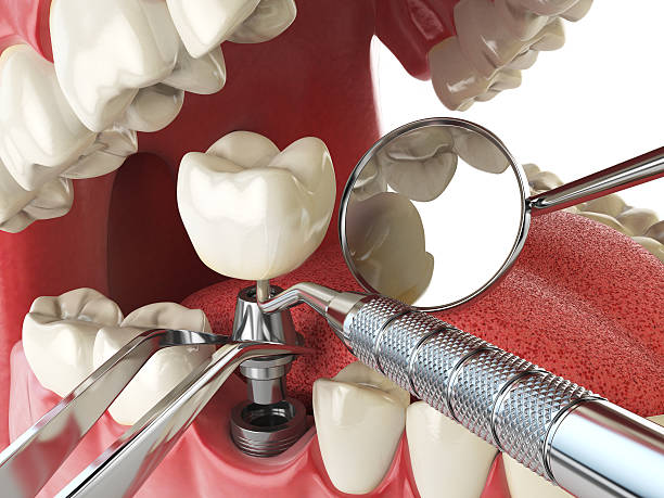 Best Emergency Tooth Extraction in Liberty, IN